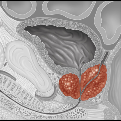 Prostate cancer illustration, bladder, medical illustration, Tara Russo